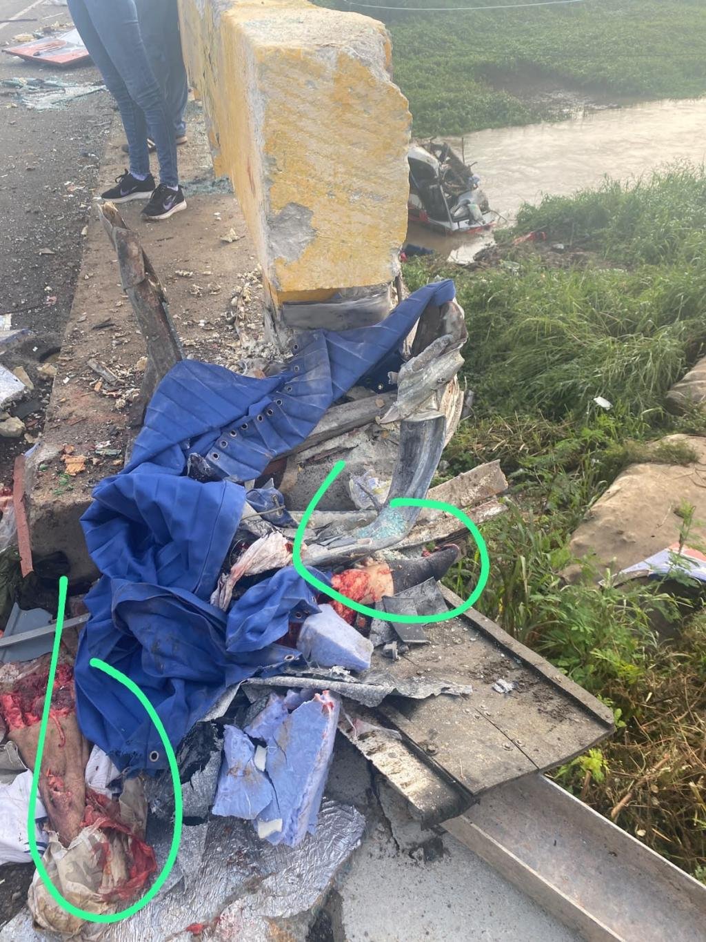 Esta sería una de las piernas de Kbeto Zuleta tras grave accidente de bus