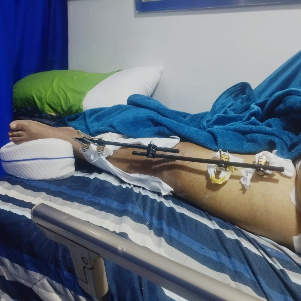 Abogado denuncia a la EPS Mutualser por negligencia  en la remisión a una clínica para ser intervenido en cirugía tras accidentarse en moto